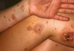 hólyagos dermatitis tünetek, panaszok kezelésére, fotó dermatiat