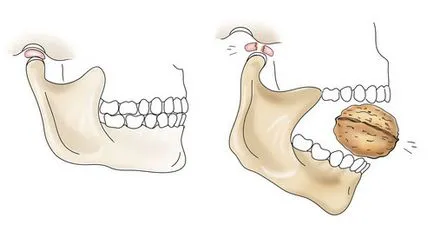 Cum dislocarea periculoasă a mandibulei, cauzele și simptomele sale
