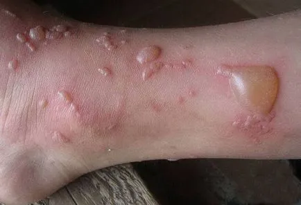 Hólyagos dermatitis tünetei és kezelése otthon