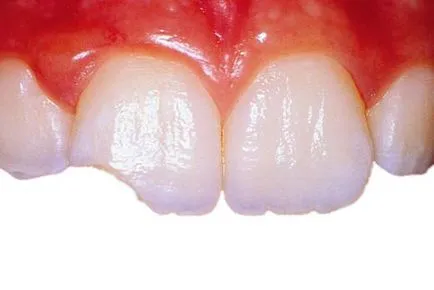 Mi a teendő, ha egy foga letört egy darab a gyermek és a felnőtt ár, okai és kezelése
