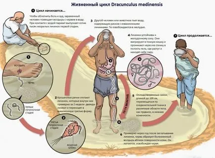 Viermele de guinea ciclu de viață vierme, simptomele și tratamentul dracunculiasis - totul despre paraziți umani