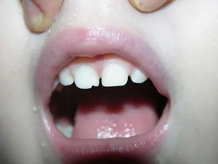Mi a teendő, ha egy foga letört egy darab a gyermek és a felnőtt ár, okai és kezelése