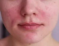 Krém és kenőcs kezelésére rosacea arc seprűvénák