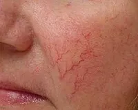 Krém és kenőcs kezelésére rosacea arc seprűvénák