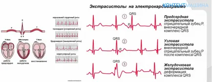 Какво е сърдечна аритмия видове, симптоми и как да го преодолее