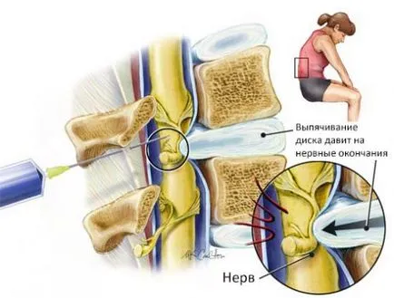 Гърба е херния функции лечение дискови
