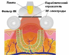 Elos-технология за премахване на целулит