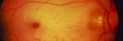 Embólia központi retina artéria - okai, tünetei és hatékony kezelése