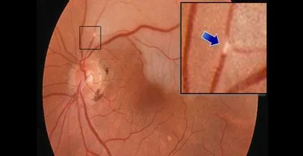 Retina artéria embólia tünetek, diagnózis és kezelés