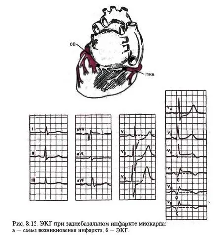 Electrocardiogram szívinfarktus tompa neki bal kamra