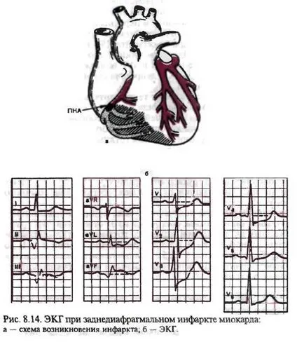 Electrocardiogram szívinfarktus tompa neki bal kamra