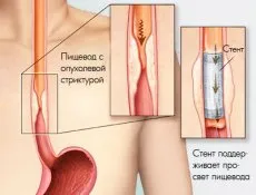 Endoszkópos stentelés tumorok a nyelőcső, és a tüdőrák