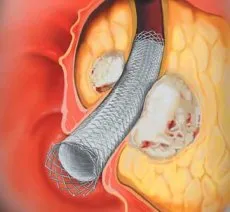 stentarea endoscopica pentru tumori ale esofagului, si cancerul pulmonar