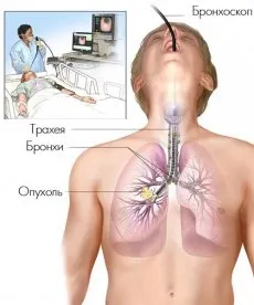 Endoszkópos stentelés tumorok a nyelőcső, és a tüdőrák