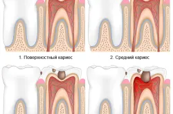 Етапи лечение на пулпит