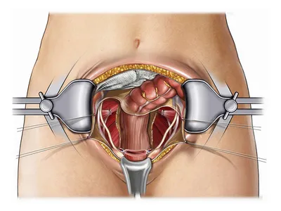 cauze de eroziune de col uterin, de prevenire și posibilele pericole