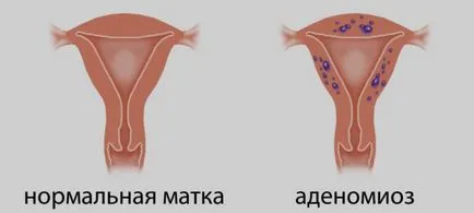 Ендометриозата след цезарово сечение и постоперативна белег