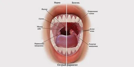 Pharyngitis kezelés, a tünetek a krónikus és akut formái felnőttek és gyermekek