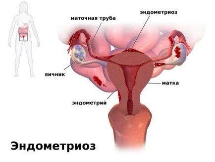 Endometrioza după cusătură cezariană cicatrice, depistarea uterin, tratamentul, prevenirea