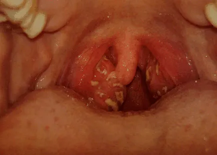 Tonsillitis tünetek és a kezelés