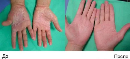 Fototerápiával psoriasis - a lényege a kezelési módszer és a hatékonyság