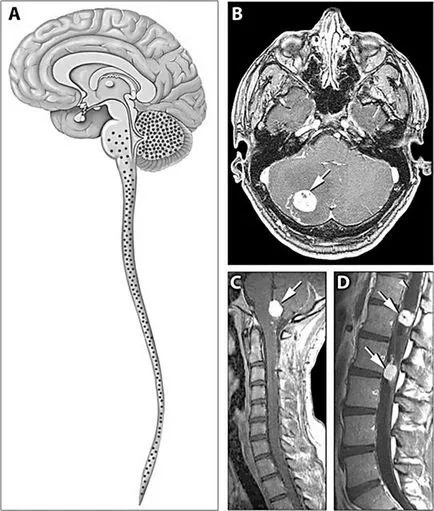 Hemangioblastomul cerebelului, creierul și măduva spinării - tratamentul, diagnosticarea și cauzele