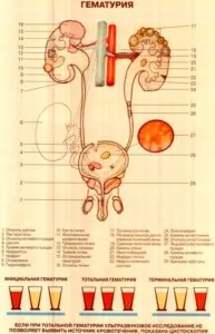 hidronefroză rinichi tratament neonatale cauze patologii