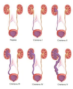 hidronefroză rinichi tratament neonatale cauze patologii