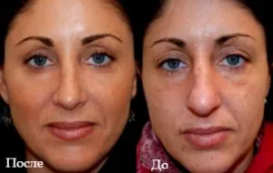 Гликолова пилинг за лице - средство за подмладяване, подобряване на еластичността на кожата