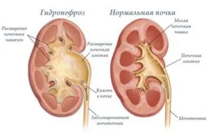 бъбрек хидронефроза неонатална лечение предизвиква патологии