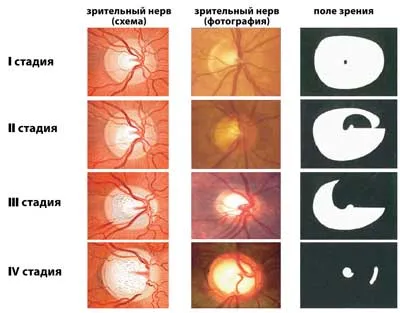 Glaucomul sale tipuri, cauze, simptome și tratament