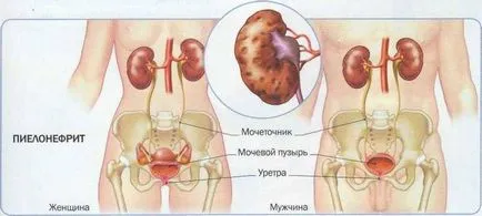 Хомеопатията за пиелонефрит и бъбречна лекарства