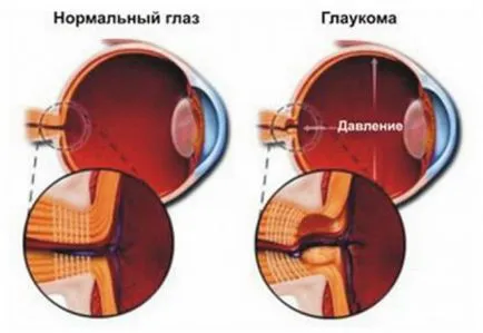 Glaucomul sale tipuri, cauze, simptome și tratament