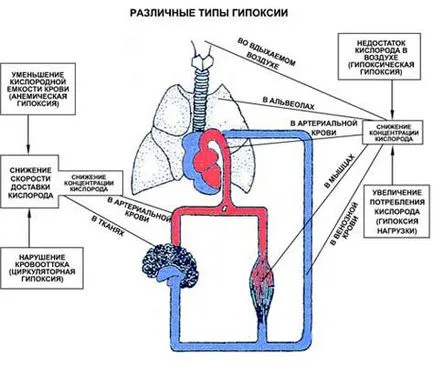 Hipoxemia și hipercapnia cauze, simptome, tratament