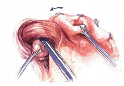 Hiatus hernia (HH), a svájci laparoszkópos