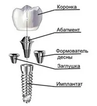 Implanturile dentare - implanturi dentare in Blagoveshchensk, implant, implanturi, dinți pastă de dinți