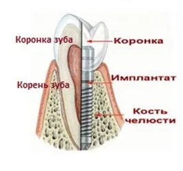 Implanturile dentare - implanturi dentare in Blagoveshchensk, implant, implanturi, dinți pastă de dinți