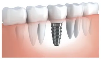 Implanturile dentare - implanturi dentare in Blagoveshchensk, implant, implanturi, dinți pastă de dinți