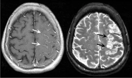 Ход MRI - лечение на сърцето