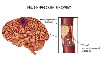 agyi infarktus, ami, tünetei és következményei