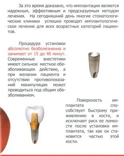 Implanturile dentare - implanturi dentare in Blagoveshchensk, implant, implanturi, dinți pastă de dinți