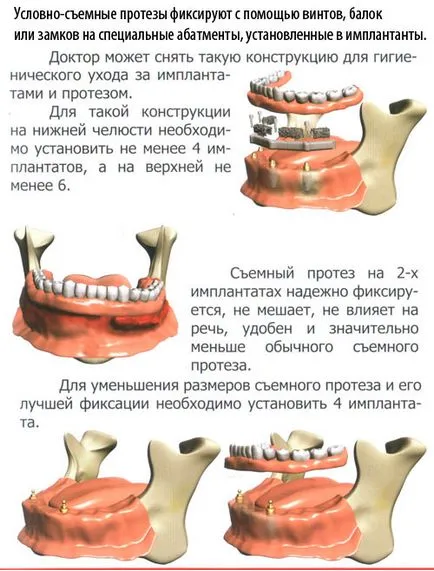 Implanturile dentare - implanturi dentare in Blagoveshchensk, implant, implanturi, dinți pastă de dinți