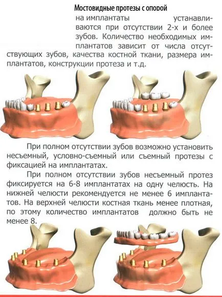 Зъбните импланти - зъбни импланти в Благовешченск, имплант, импланти, паста за зъби зъби