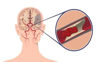 Ischaemiás stroke okai, következményei, a kezelés