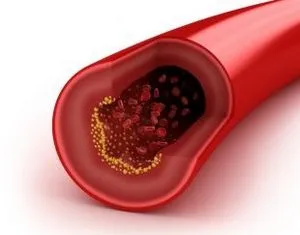 Hogyan lehet hatékonyan kezelni atherosclerosis - Tünetek és okok! Előadás a