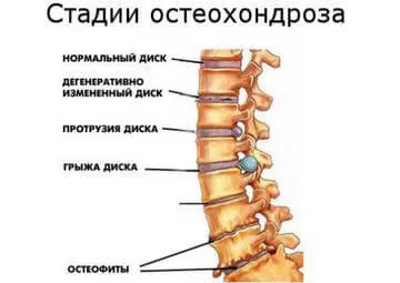 Йога с цервикална остеохондроза