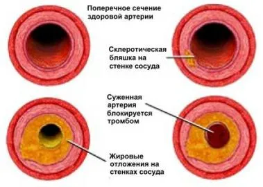 Cum de a diagnostica ateroscleroza și dacă aceasta poate fi evitată