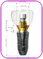 Mit teszünk implantátumok - implantátum telepítés - Galaxy