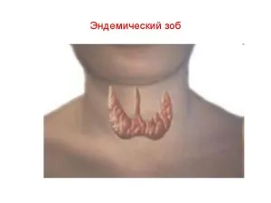 Какво размери на щитовидната жлеза са нормални