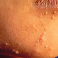 Cum de a trata molluscum contagiosum la copii in casa